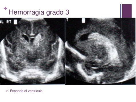 Transfontanelar Ultrasound Technique, Normal Anatomy